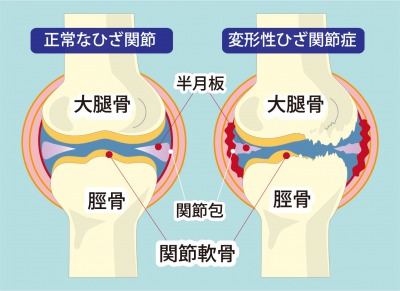 正常なひざ関節と変形性ひざ関節症の比較